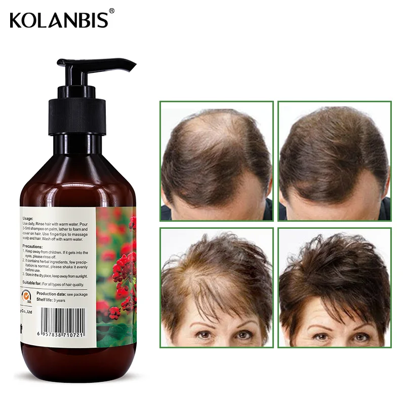 Отрастания волос против выпадения волос шампунь для контроля масла для лечения выпадения волос 300 мл