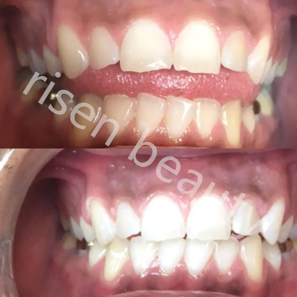 Super teeth whiten kit with teeth whiten gel/wholesale dental teeth whitening