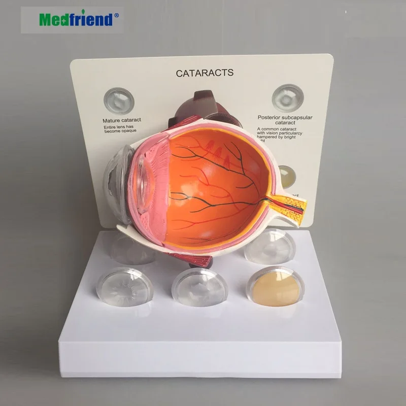 Factory Price Advanced Anatomical Cataracts Model