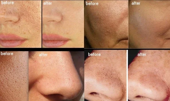 portable 6 in1 frozen skin h2o2 aqua skin peel oxygen facial machine portable