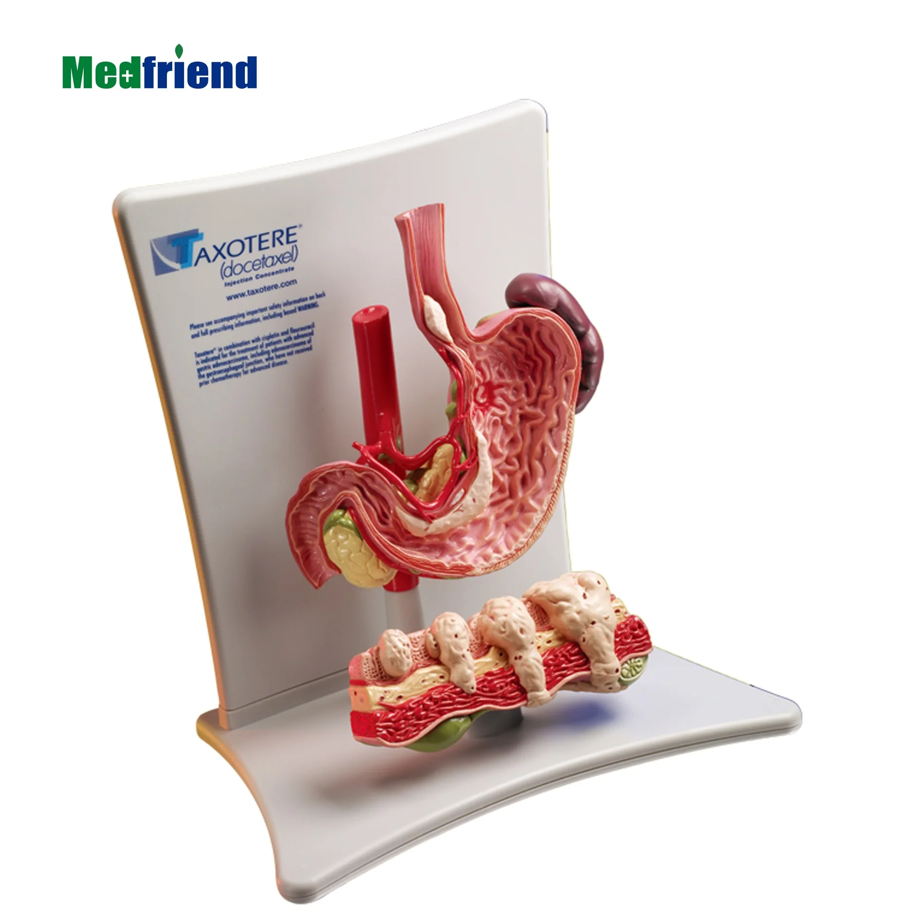 
Factory Price Advanced Anatomical Stomach Cancer Model 