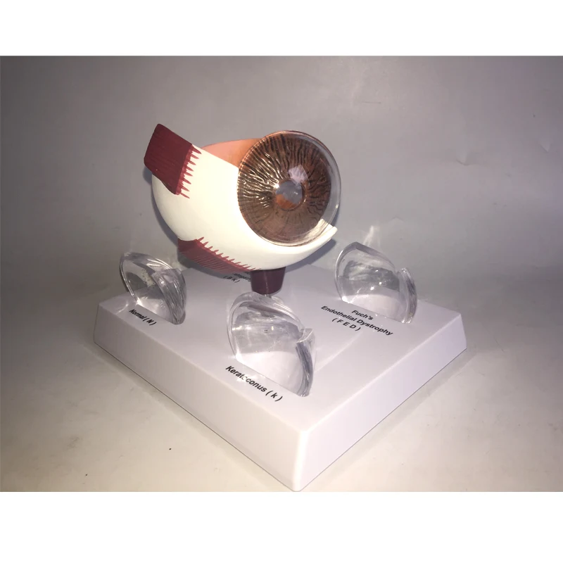 Cornea Eye Conditions Medical Anatomical Human Corneal Disease Model