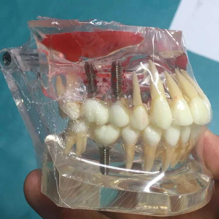 New sinus lift model implant and restoration dental model