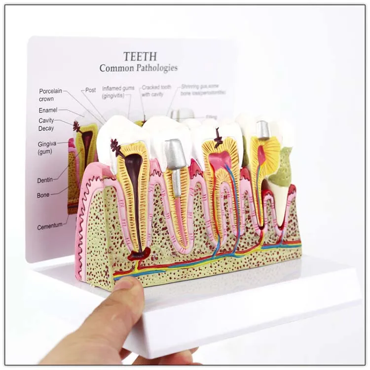 Dental Study Plastic Periodontal Teeth Human Medical Decay Common Pathologies Teeth Model