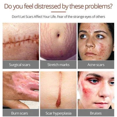 Factory Price VG Crocodile Repair Scar Remove Serum Acne Treatment Anti Acne Shrink Pores Blackhead Whitening Cream