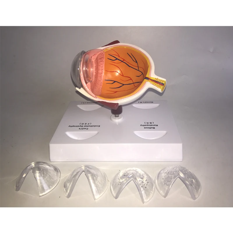 Cornea Eye Conditions Medical Anatomical Human Corneal Disease Model