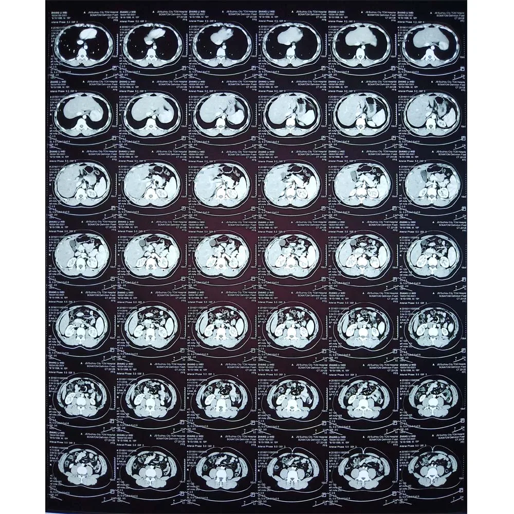 
high resolution medical dry imaging film x-ray digital blue film for ct cr mri diagnosis from China 