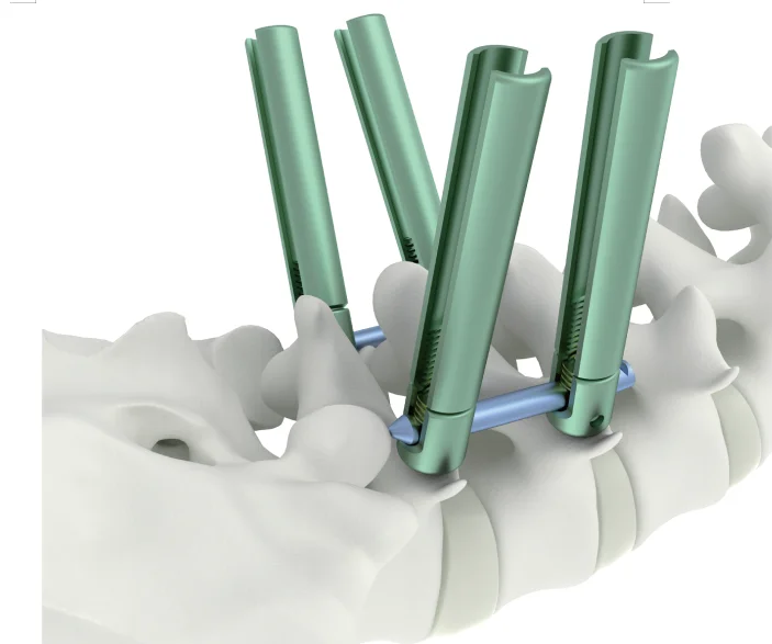 Minimally Invasive Spine System-Monoaxial Screw