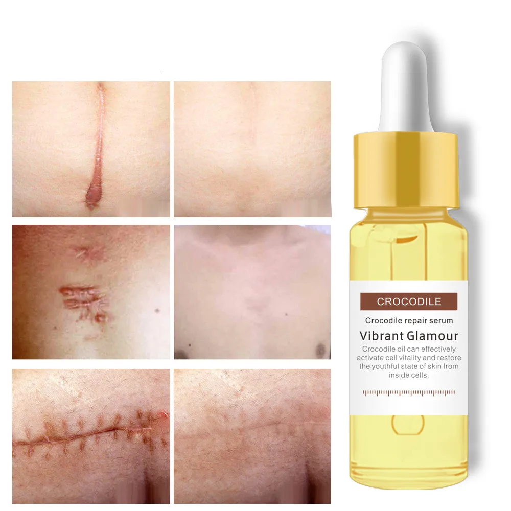 Factory Price VG Crocodile Repair Scar Remove Serum Acne Treatment Anti Acne Shrink Pores Blackhead Whitening Cream
