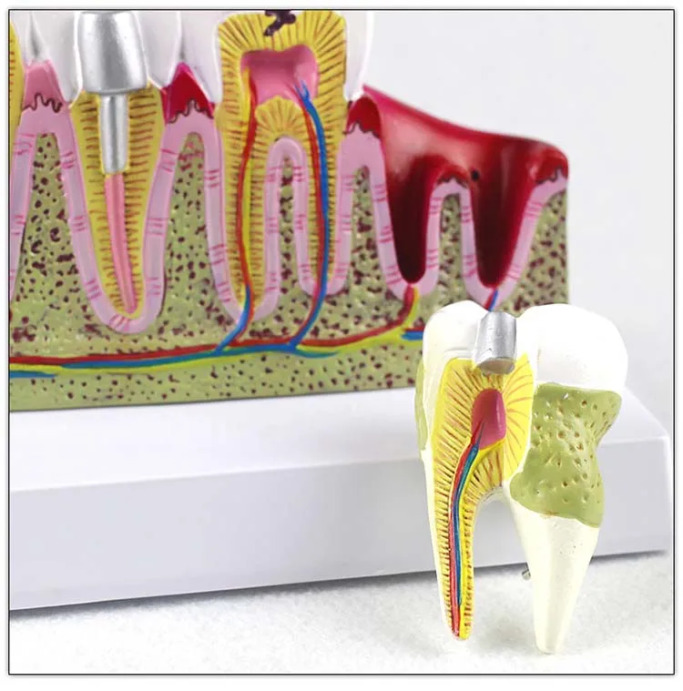 Dental Study Plastic Periodontal Teeth Human Medical Decay Common Pathologies Teeth Model
