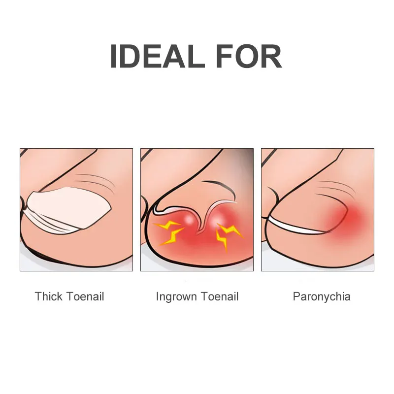 ABS Handle Double Spring Ingrown Toenail Trimming Cutter Pedicure Manicure Tools Podiatry Feet Care Stainless Steel Nail Clipper