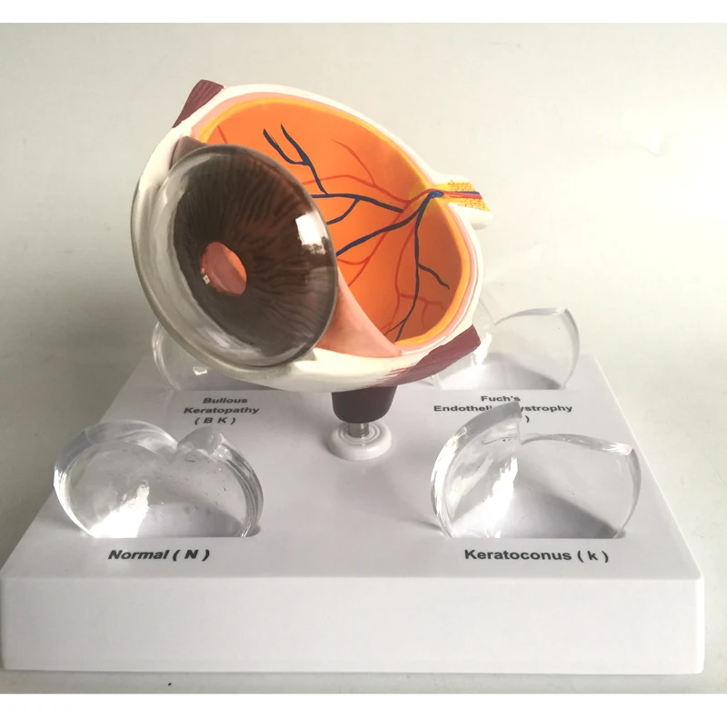 Cornea Eye Conditions Medical Anatomical Human Corneal Disease Model