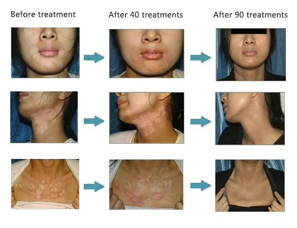 UVB Lamps- Psoriasis, vitiligo clinic machine uv lamp technology for the patient