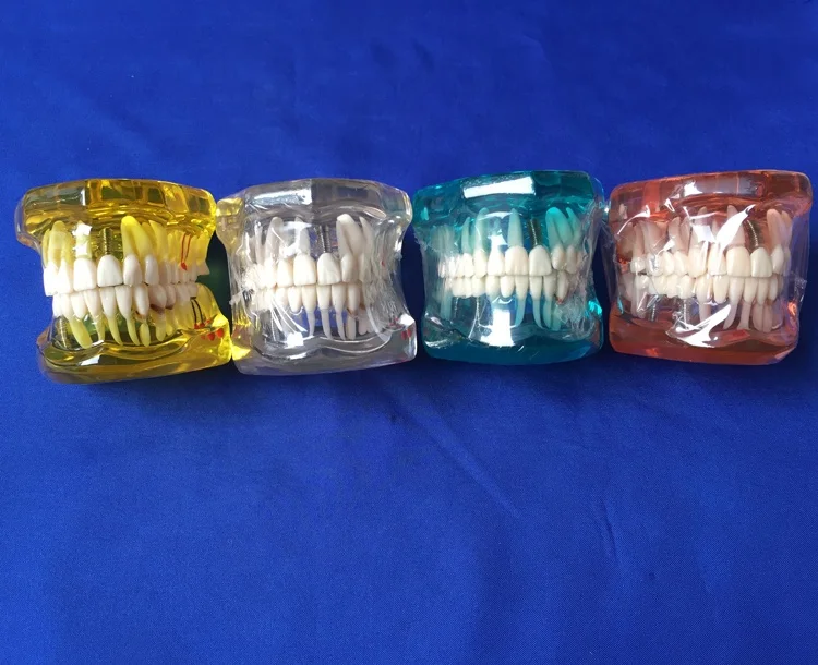 Tooth Restoration model with Implant