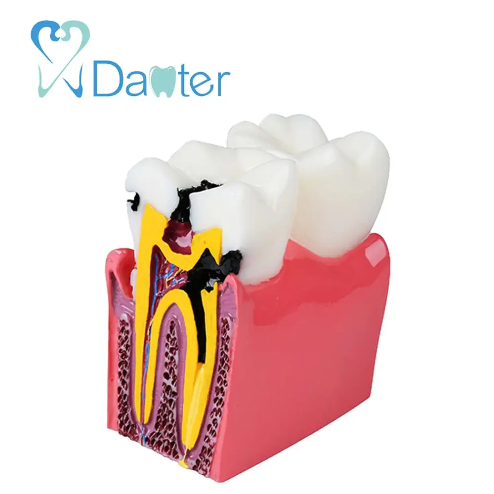 High Quality Caries Model Tooth Model for Dentist Patient Communication