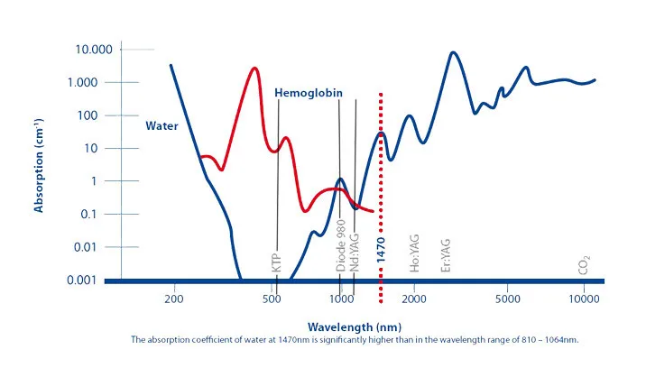 Endovenous Laser Ablation