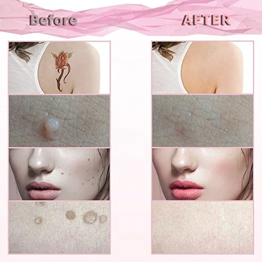 
Portable Skin Tag Removal Sweep Spot Pen Tool Electric Mole Remover Pen 