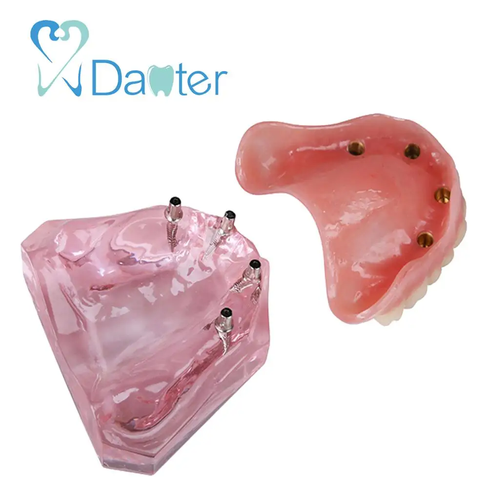 Newest Dental Overdenture Model Interior Maxillary with 4 Implant Restoration for Dental Study