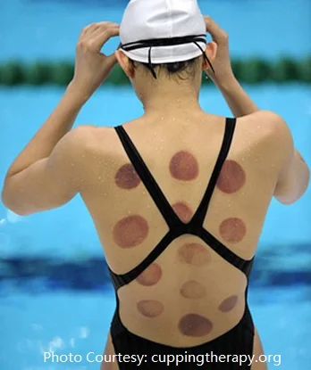 
massage grade back cupping/magic hijama therapy gifts/TCM perfect device 