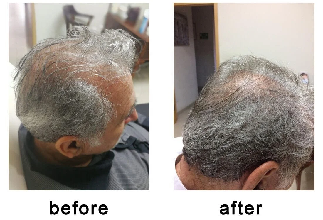 
Hair Loss Treatment Otesaly Mesotherapy Solution Serum for Hair Growth 