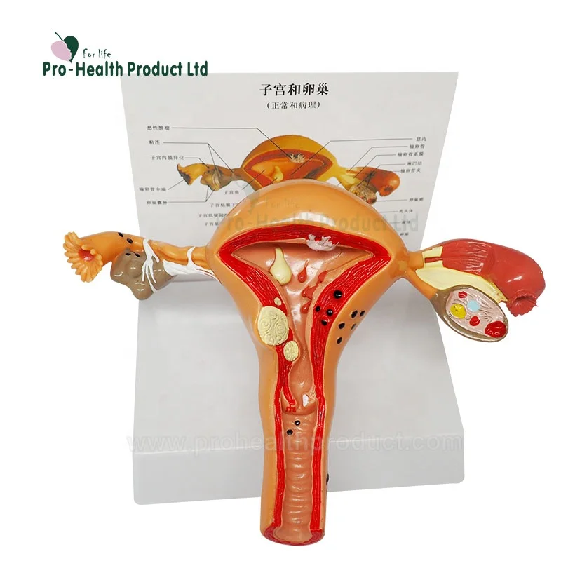 Female Pathological 3D Plastic Uterus Ovary Anatomical Model