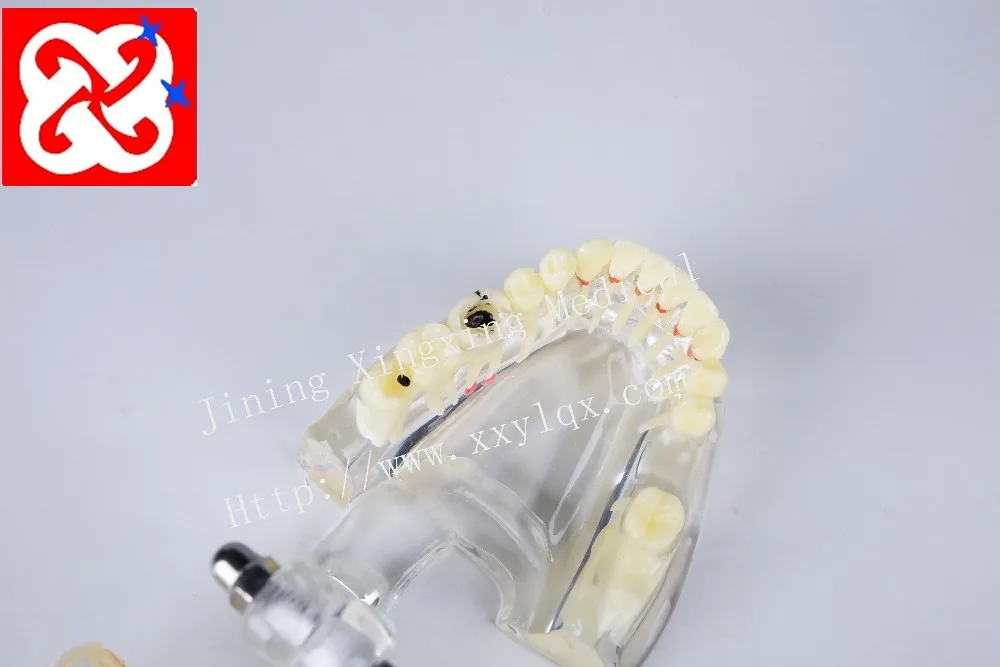 Adult pathological dental model with missing tooth caries apical cyst, tartar ,implant etc