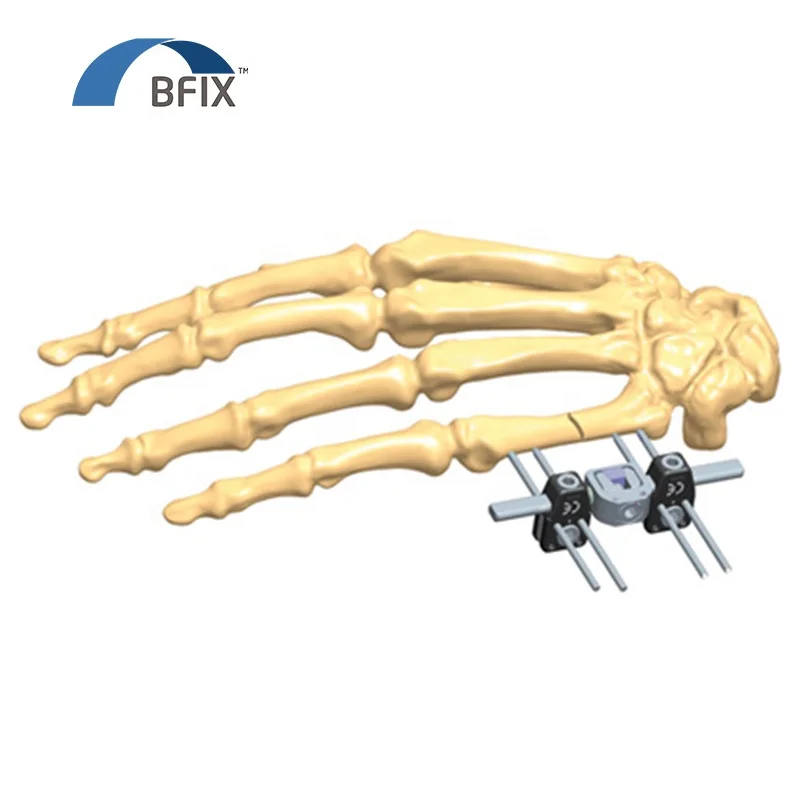 
Ортопедический внешний фиксатор для излома вала 5-го metacarpal мини-фиксатор 
