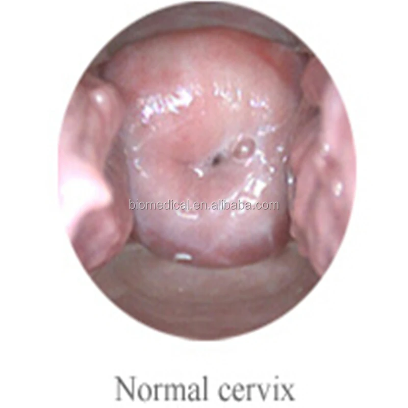 Vagina Endoscopy Colposcope Vaginal Camera Scope With Optional Screen