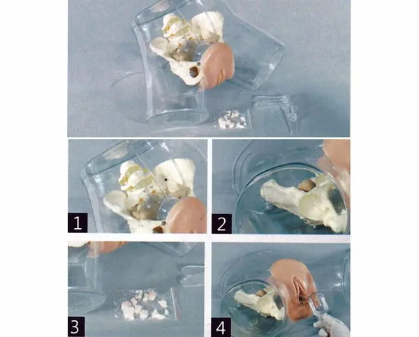 Transparent Uterine Curettage Simulator, Surgical Abortion Model