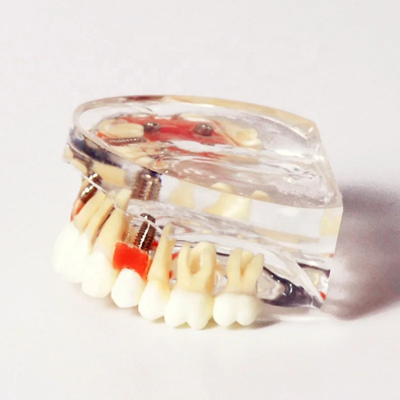 Демонстрационная модель имплантации с одной короной и мостом