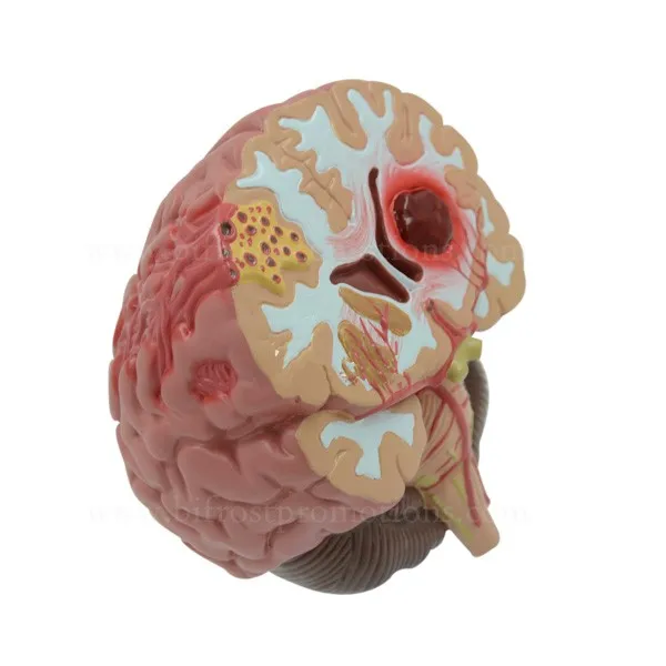 Organs Human Body Anatomy Brain Model Of Stroke