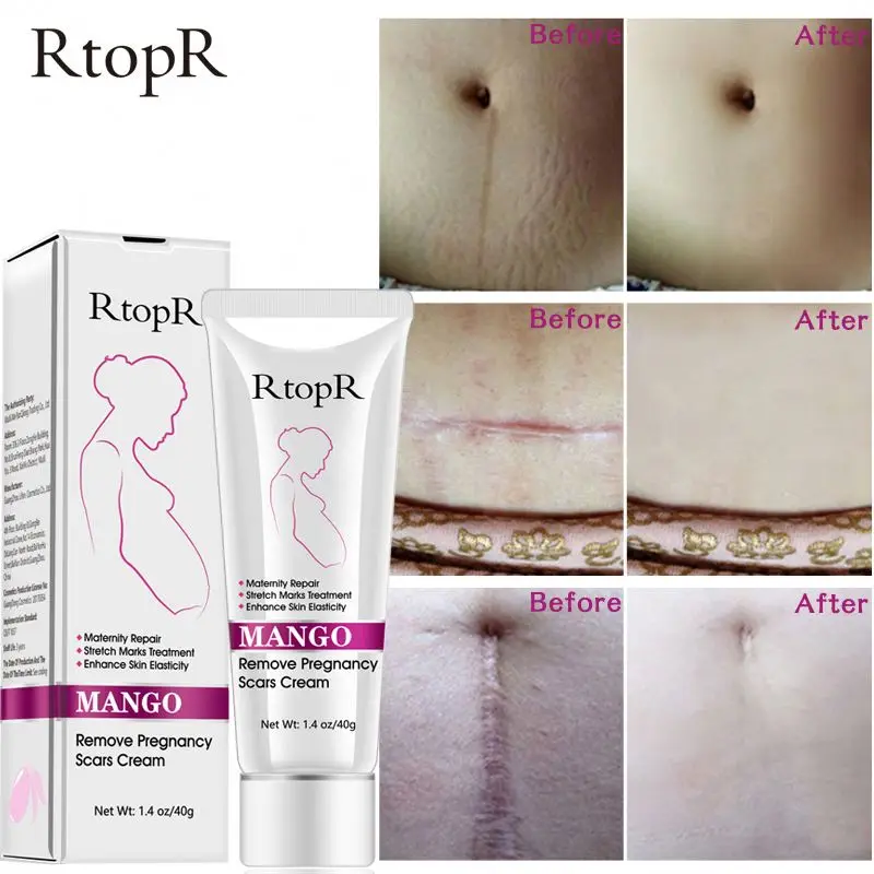 
2019 popular Mango Remove pregnancy scars skin care cream for Stretch marks treatment 