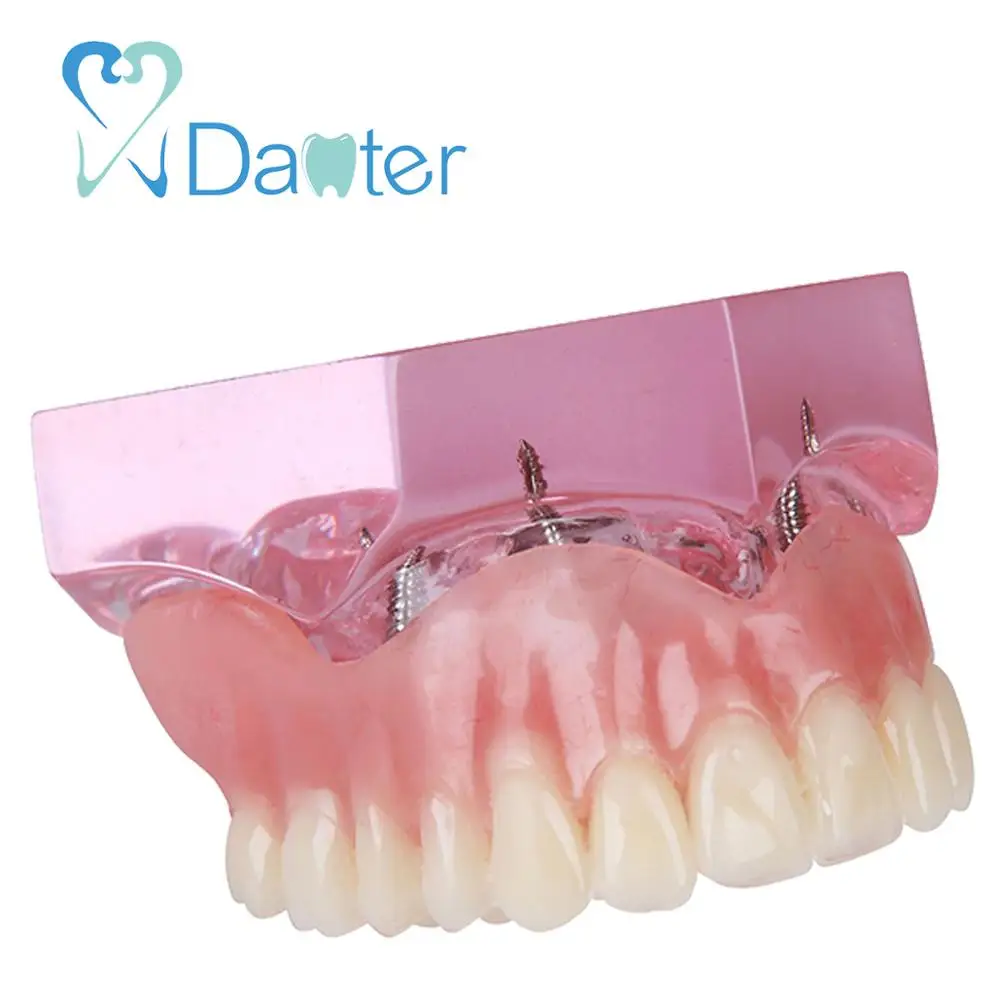 Newest Dental Overdenture Model Interior Maxillary with 4 Implant Restoration for Dental Study