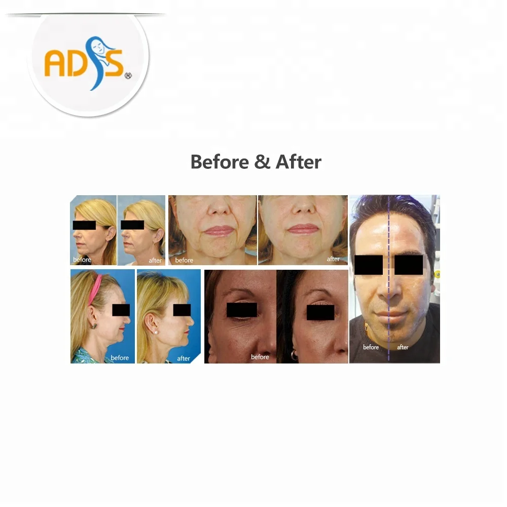 ADSS HIFU face lift machine portable HIFU for sale