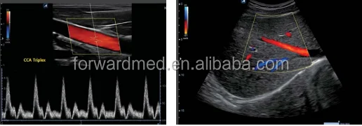 Portable Ultrasound in color doppler ultrasound equipments