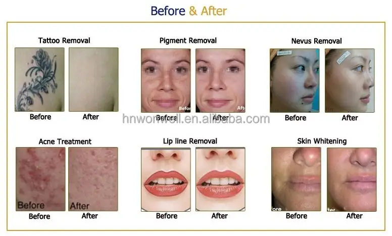 Erbium yag laser Q Switch Nd yag laser