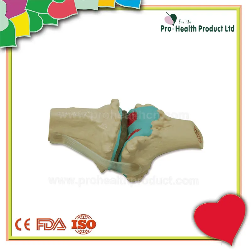 Joint Disease Knee Lesions Arthritis Knee Osteoarthritis Model Four Stage Degenerative