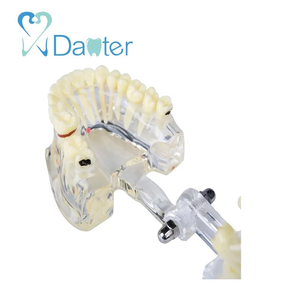 Adult Dental Pathologies Teeth Model with Missing Teeth for showing caries apical cyst tartar implant impaction missing teeth