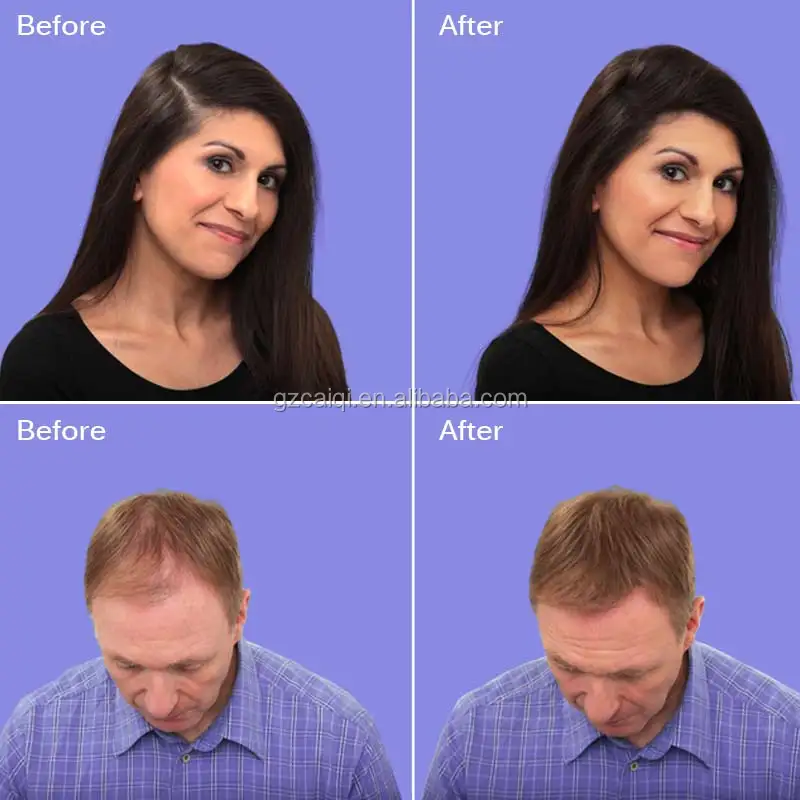 Mokeru Hair Growth Medicine And Naturel Hair Growth lotion For Baldness person