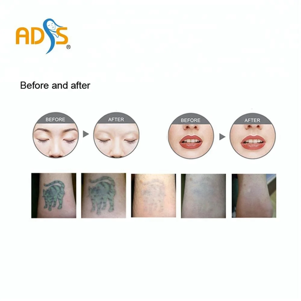 2024  cheapest  Laser tattoo removal ----RY 580  TATTOO REMOVAL SKIN REJUVENATION