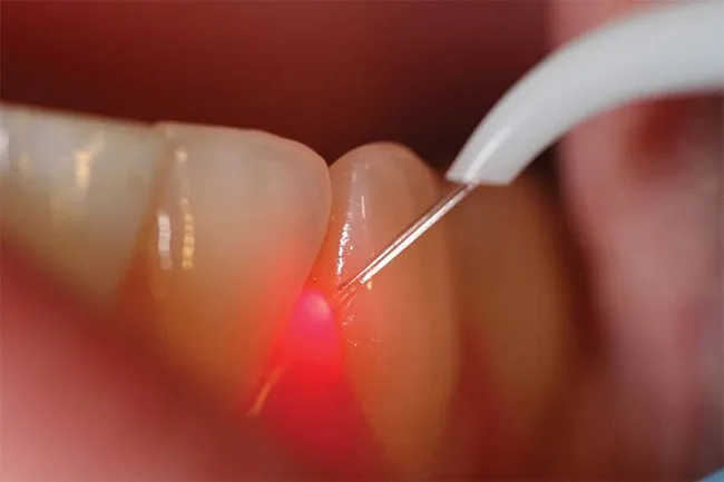 dental laser for Exposure of implants/ 980nm diode dental laser