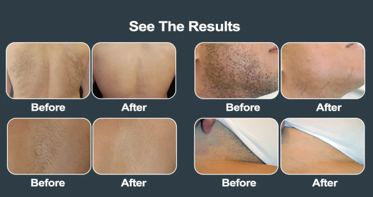 
OSANO professional 808nm painless hair removal machine laser 808 diode 