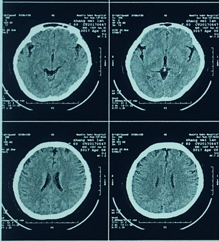 Inkjet medical x-ray film 11*14 inch for HD dicom printer