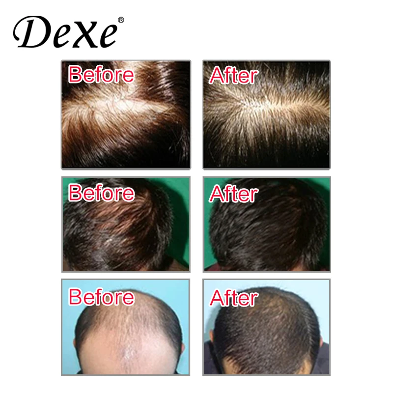 
Hair Regrowth Grow For Men And Women Hair loss treatment shampoo spray lotion anti hair fall 