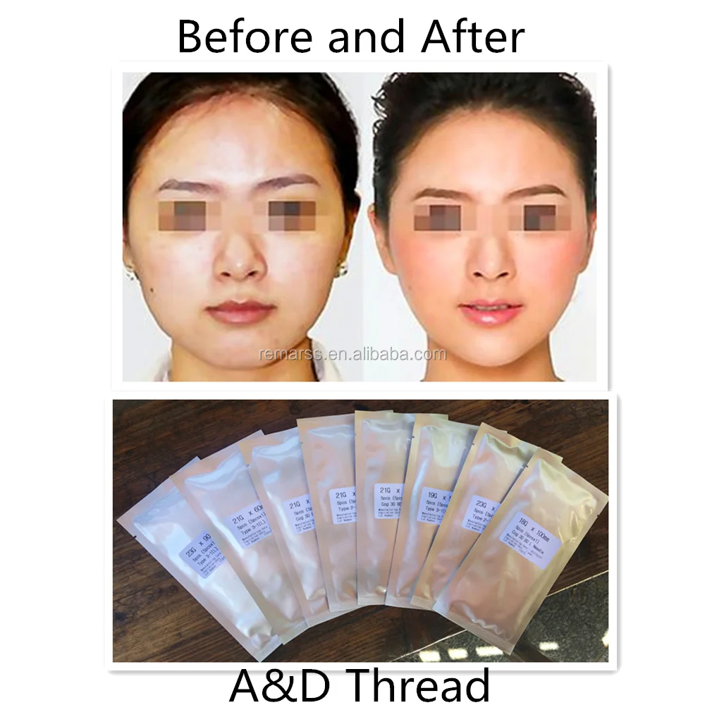 
korea polydioxanone suture fio lifting pdo double needle cog thread 