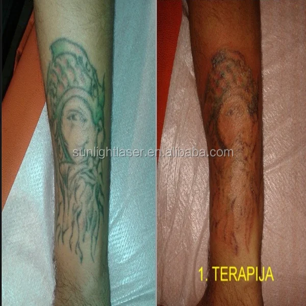 
More Effective tattoo removal laser equipment 