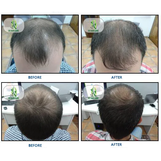 650nm laser diode hair growth products