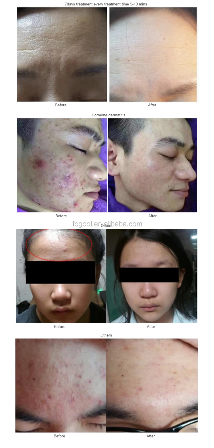 
3 in 1 removing eye bags machines plasma pen device plasma bt 