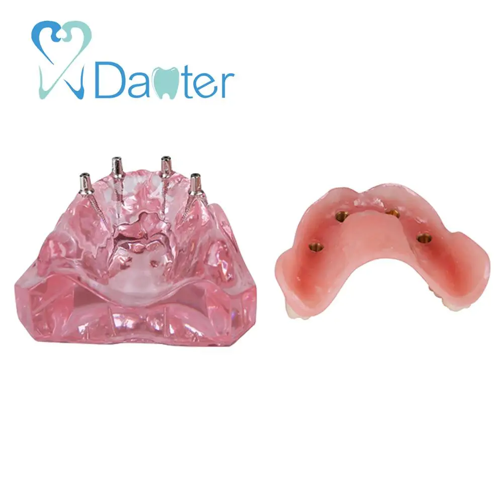 Newest Dental Overdenture Model Interior Maxillary with 4 Implant Restoration for Dental Study