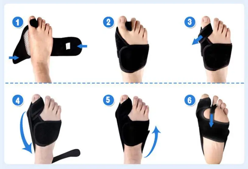 2021 RS factory price medical tourmaline hallux valgus orthosis